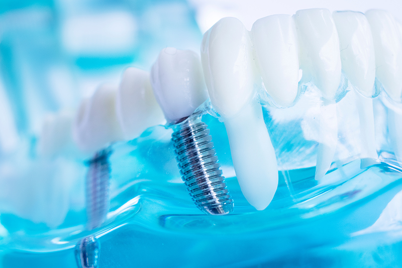 Richmond Landing Family Dentistry | Teeth Whitening, Periodontal Treatment and Dental Bridges